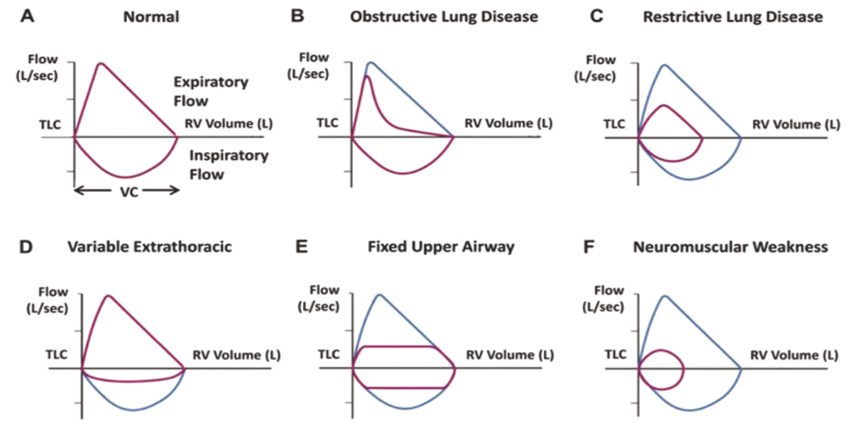 Spirometry